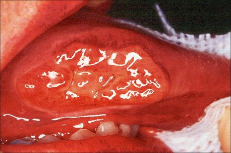 Fig. 11.55, Traumatic ulcerative granuloma: this patient had bitten her tongue during a seizure and the indurated mass developed over a few days.