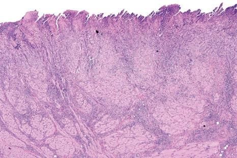 Fig. 11.56, Traumatic ulcerative granuloma: note the ulcerated surface and the penetrating inflammation that separates muscle fascicles.