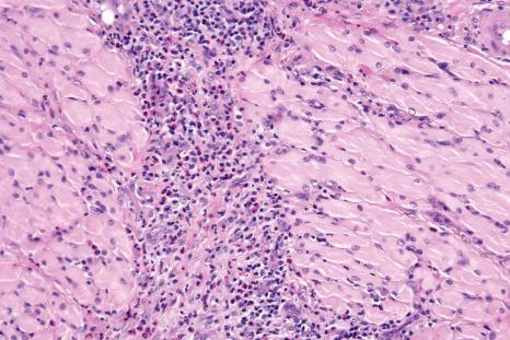 Fig. 11.57, Traumatic ulcerative granuloma: there is prominent interfascicular inflammation and muscle degeneration.