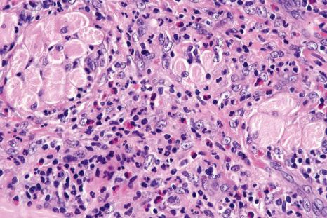 Fig. 11.58, Traumatic ulcerative granuloma: note the presence of histiocytes and many eosinophils.