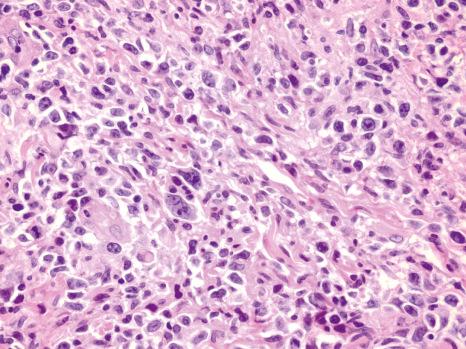 Fig. 11.60, Epstein-Barr virus mucocutaneous ulcer: many atypical lymphocytes with pleomorphic nuclei with irregular contours (Reed Sternberg-like) are present