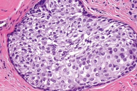 Fig. 11.6, Odontogenic rest of Serres in the gingiva: this is composed of mainly clear cells (inset).