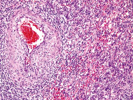 Fig. 11.62, Epithelioid hemangioma: there is a proliferation of epithelioid endothelial cells in sheets, with many lymphocytes and fresh hemorrhage.