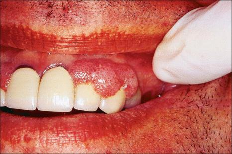 Fig. 11.67, Condyloma acuminatum: this larger warty lesion on the gingiva occurred in a patient on long-term immunosuppression after lung transplantation.