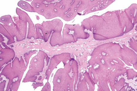 Fig. 11.68, Condyloma acuminatum: unlike squamous papilloma, the rete ridges are large and bulbous and koilocytes are readily identified.