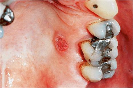 Fig. 11.69, Verruciform xanthoma: note the warty sessile lesion on the left hard palate.