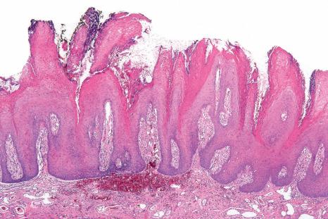 Fig. 11.70, Verruciform xanthoma: there is marked brightly eosinophilic parakeratin and papillomatosis with confluence of rete ridges at the tips.