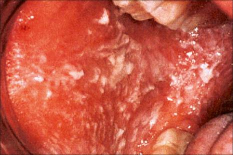 Fig. 11.7, White sponge nevus: typical white, thickened, spongy-appearing mucosa.