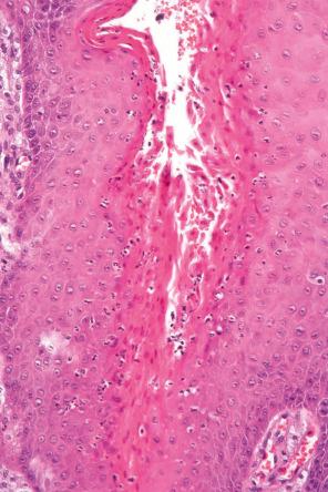 Fig. 11.71, Verruciform xanthoma: parakeratotic squames on the surface of the keratin and in the crypts are a characteristic feature; spongiotic pustules are often present.