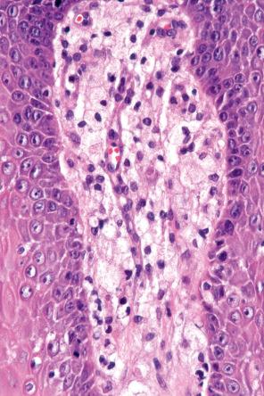 Fig. 11.72, Verruciform xanthoma: the lamina propria contains numerous foamy macrophages.