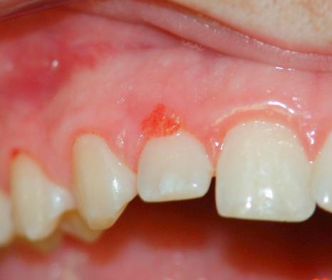 Fig. 11.73, Localized juvenile spongiotic gingival hyperplasia: there is an erythematous papule on the gingiva with a slightly papillary surface.