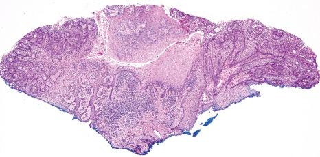 Fig. 11.74, Localized juvenile spongiotic gingival hyperplasia: there is a benign papillary proliferation of nonkeratinized stratified squamous epithelium with marked spongiosis.