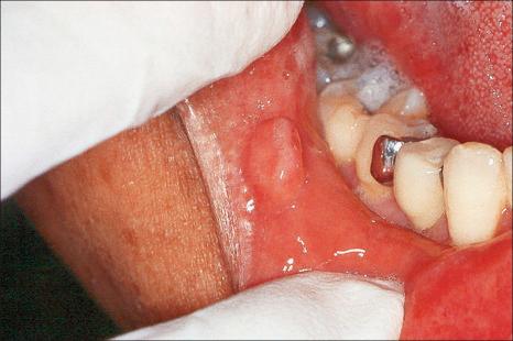 Fig. 11.76, Fibroma: there is a fleshy pink sessile mass on the lower lip mucosa.