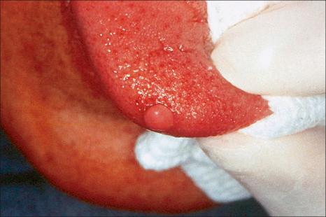 Fig. 11.77, Fibroma: there is a fleshy, polypoid nodule on the lateral border of the tongue.