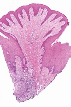 Fig. 11.80, Giant cell fibroma: note the undulating surface and spiky rete ridges.