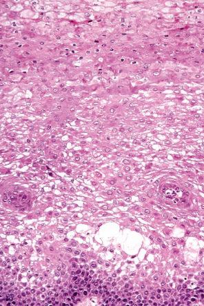 Fig. 11.8, White sponge nevus: the epithelium exhibits vacuolation, acanthosis, and dyskeratosis.