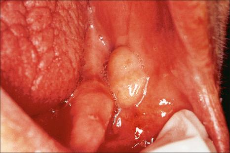 Fig. 11.82, Lipoma: note the yellowish, sessile nodule on the buccal mucosa.