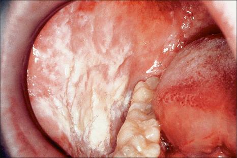 Fig. 11.10, Hereditary benign intraepithelial dyskeratosis: the mucosa appears white and thickened.