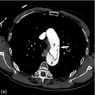 Figure 20.1, Contrast-enhanced CT-scan of a Stanford Type-B aortic dissection. The axial image (a) clearly shows a defect in the intima wall (arrow), allowing blood to flow from the original true lumen (T) into the vessel wall, as such, creating a second false (F) lumen. A second oblique sagittal reformatted image of the same patient (b) shows that the resulting dissection flap (arrow) has its origin just distally from the ostium of the unaffected left subclavian artery, a typical location for a classic Stanford type-B dissection.