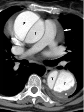 Figure 20.2, Contrast-enhanced CT-scan of a Stanford type-A aortic dissection. The axial CT image shows a double-barreled aortic lumen, consisting of a small true lumen (T) and a larger false (F) lumen. Note the difference in contrast enhancement between these two channels, reflecting a different flow speed. The slower flow in the false lumen further contributes to the forming of thrombus material adjacent to the posterior aortic wall (*). Also, there is an overall increase in diameter of the affected aorta as a post-dissection aortic dilatation settles in secondary to decreased wall strength. Finally, a pericardial effusion can also be appreciated (arrow), a common finding in Stanford Type-A aortic dissections.