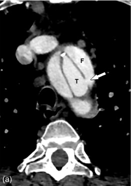 Figure 20.3, Contrast-enhanced CT-scan of an aortic dissection initially originating in the proximal descending aorta, but with retrograde extension into the ascending aorta. The axial image (a) shows a clear defect in the aortic wall (arrow), as entry site for a classic Stanford type-B aortic dissection with two channels of flowing blood: the true (T) and false (F) lumen. The sagittal reformatted image (b) shows retrograde extension of this dissection into the aortic arch and ascending aorta. However, in contrast to the initial rupture in the descending aorta, the dissection flap (arrows in b) does not have a re-entry site. As a consequence, in the ascending aorta the false lumen contains stagnant blood, with thrombus from the aortic sinus upwards, as such forming an intramural hematoma (IMH in b, c). An axial image at a mid-level of the ascending aorta (c) shows that the intramural hematoma (arrows) has a slight hyperdense appearance, and can be distinguished from a large pericardial effusion (asterisk). These images show an initially Stanford type-B dissection with a secondary retrograde acquired Stanford type-A dissection, in which both intramural hematoma and classic dissection are simultaneously present in the same patient.