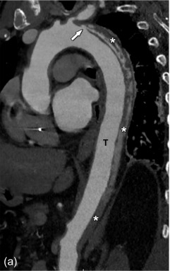 Figure 20.4, Contrast-enhanced CT examinations of the same patient within a time span of a week, initially presenting with acute chest pain. The first CT examination (a, b) shows a Stanford type-B dissection starting just distally from the ostium of the left subclavian artery and ending just above the renal arteries. However, while the entry site is clearly visible (arrow in a), there is no identifiable exit site. As such, the false lumen if formed by an intramural hematoma consisting of mostly stagnant blood (asterisk in a, b). Six days later, the patient was re-evaluated on clinical grounds. The second CT examination (c, d) now shows multiple new defects in the dissection flap (asterisks in c, d). With the development of these multiple entry and exit sites, the false lumen contains now flowing blood. The now increased pressure in the false lumen pushes the dissection flap inwards (arrow in d), with true and false lumen now having similar dimensions.