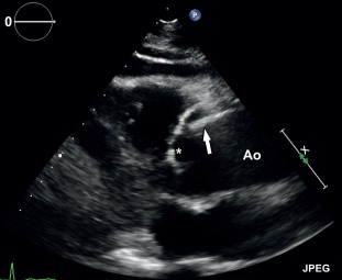 Figure 20.5, Parasternal long-axis transthoracic echocardiographic image demonstrating a Stanford type-A dissection with a hyperechogenic dissection flap (arrow). Ao: aorta, asterisk: aortic valve.