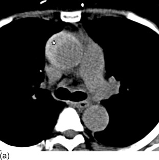 Figure 20.6, CT examination of a type-A dissection presenting as an intramural hematoma. Axial (a) and sagittal (b) unenhanced CT images. The spontaneous hyperdense acute intramural hematoma (asterisks) is clearly seen on these unenhanced CT images. Note the typical semicircular crescent-like shape of the hematoma, and the extension into the aortic sinus (arrow in b).