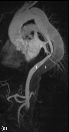 Figure 20.7, Follow-up of a Stanford type-B aortic dissection in a 52-year-old man. Sagittal reformatted T1-weighted images after intravenous contrast administration, acquired in arterial (a) and venous (b) phase. These MR angiography images demonstrate the presence of a double-barreled aortic lumen, consisting of a true (T) and false (F) lumen. In the first-pass arterial images (a) the true lumen is nicely enhanced with almost no opacification of the false lumen. The image acquired 60 s (b) later now shows the delayed enhancement of the false lumen, compatible with slower flow. In this contrast phase, the contrast in the true lumen has almost completely washed out. This example shows the dynamics on contrast-enhancement of the different lumina within an aortic dissection.