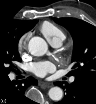 Figure 20.8, A 72-year-old of Southeast Asian origin with complaints of chest pain. Note two partially thrombosed aneurysms (asterisk) with a diameter of approximately 3 cm of the left circumflex coronary artery. The patient reported having been diagnosed with Kawasaki disease as a child.