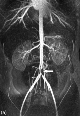 Figure 20.9, Takayasu disease in a 25-year-old female with intermittent claudication. In the maximum intensity projection image of the first-pass MR angiography (a) a smoothly delineated stenosis in the distal aorta with a typical “hour-glass” morphology (arrow) is seen. Corresponding axial T1-weighted images performed before (b) and after (c) intravenous contrast administration show concentric wall thickening with intense enhancement after contrast (arrow).