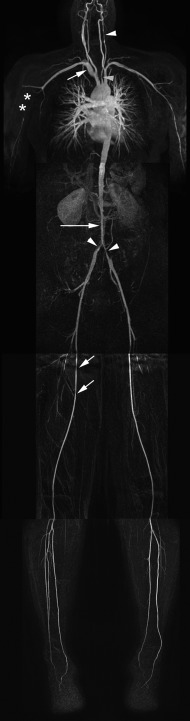 Figure 20.10, A 29-year-old female with long-standing complaints of lower and upper extremity intermittent claudication due to Takayasu disease. Note the multiple smooth, short segmental stenoses (arrowheads), as well as aneurysmal dilatation of the proximal right subclavian artery (short, upper arrow) and a somewhat longer segmented stenoses in the distal abdominal aorta (long arrow) and common iliac arteries (short, lower arrows). These findings are characteristic of circumferential vessel wall thickening due to inflammation. The right brachial artery is nearly occluded (asterisks).