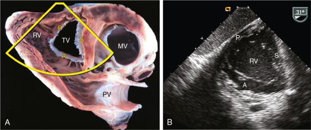 Fig. 23.1, Normal Tricuspid Valve Anatomy.