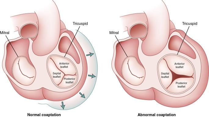 Fig. 23.2, Coaptation of the Tricuspid Valve (Video 23.2 ).