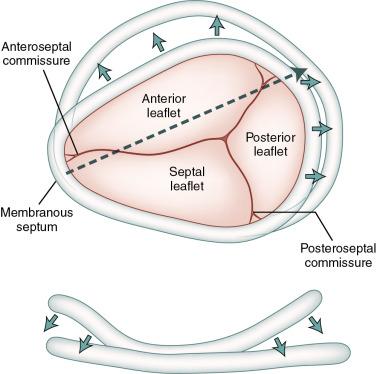 Fig. 23.3, Tricuspid Annular Dilation With Functional Tricuspid Regurgitation (Video 23.3 ).