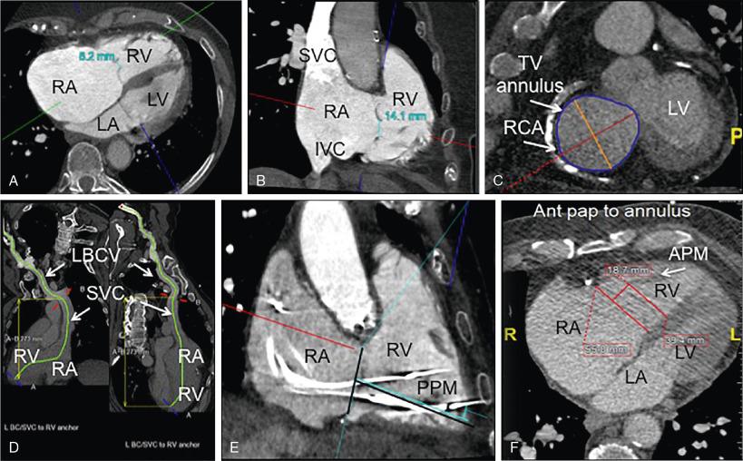 Fig. 23.4, Computed Tomography for Procedural Planning for Transcatheter Tricuspid Valve Repair.