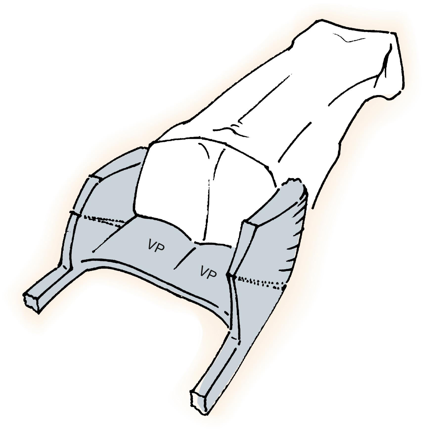 Fig. 8.1, “Three-sided box” of ligaments provides strength with minimal bulk. At least two sides of this box must be disrupted for displacement of the joint to occur. VP, Volar plate.
