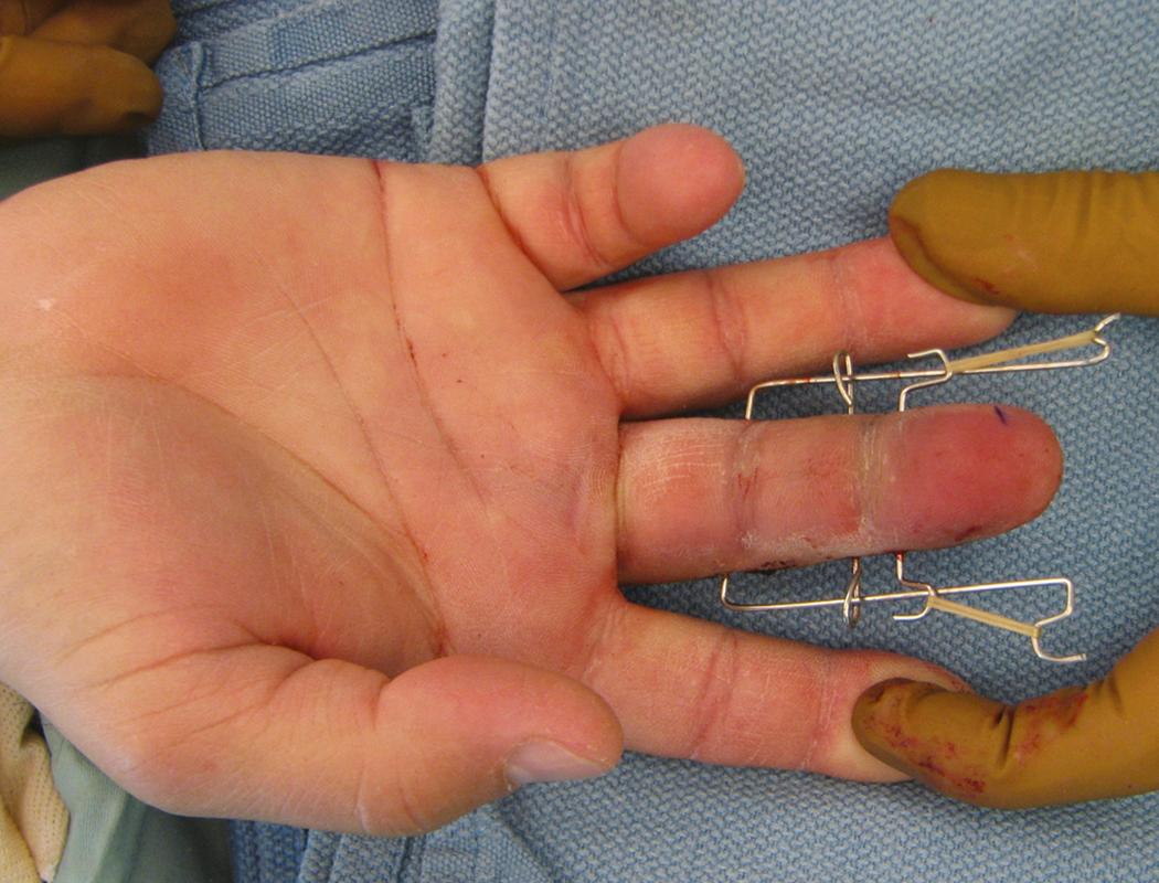 Fig. 8.11, A third wire is added in midaxial line through middle phalanx. By placing this dorsal to the proximal phalangeal wire, a volar-directed moment is applied to the joint to prevent dorsal subluxation without excessive traction.