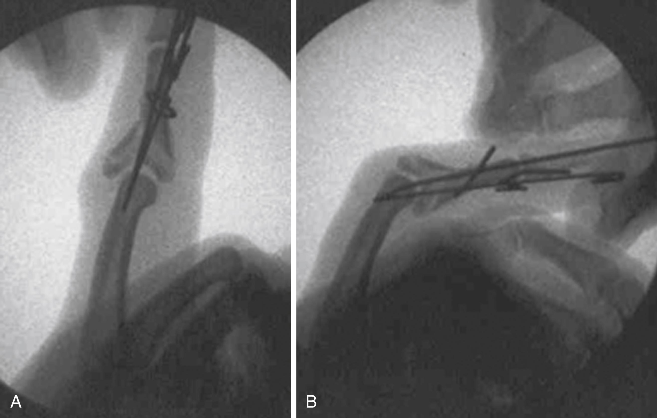 Fig. 8.12, Full extension is typically the most unstable position. A, Lateral radiograph shows some overall widening or cupping at the joint, but no subluxation or secondary incongruity. B, Lateral view with joint flexed also shows congruity.