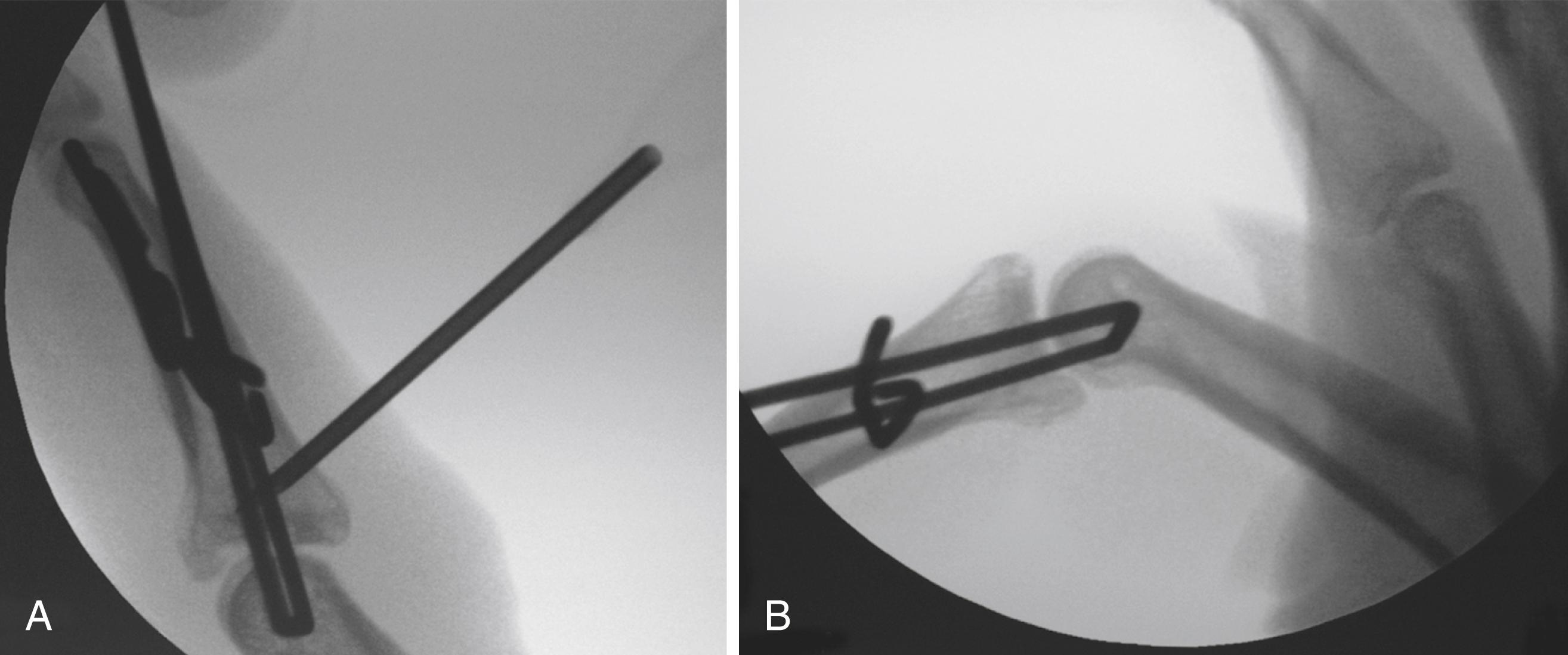 Fig. 8.13, A, Percutaneous introduction of 18-gauge needle to elevated impacted fragments. B, Reduction after tension is applied to the dynamic fixator and joint is reduced percutaneously.