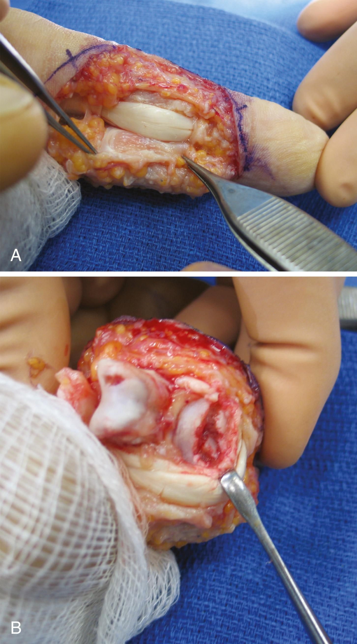 Fig. 8.14, Shotgun approach for proximal interphalangeal joint exposure. A, Flexor sheath between A2 and A4 pulleys is incised along one edge and elevated. When closing, it can be passed under the tendon to prevent adhesions at repair site. B, After recession of collaterals, joint can be “shotgunned” open.