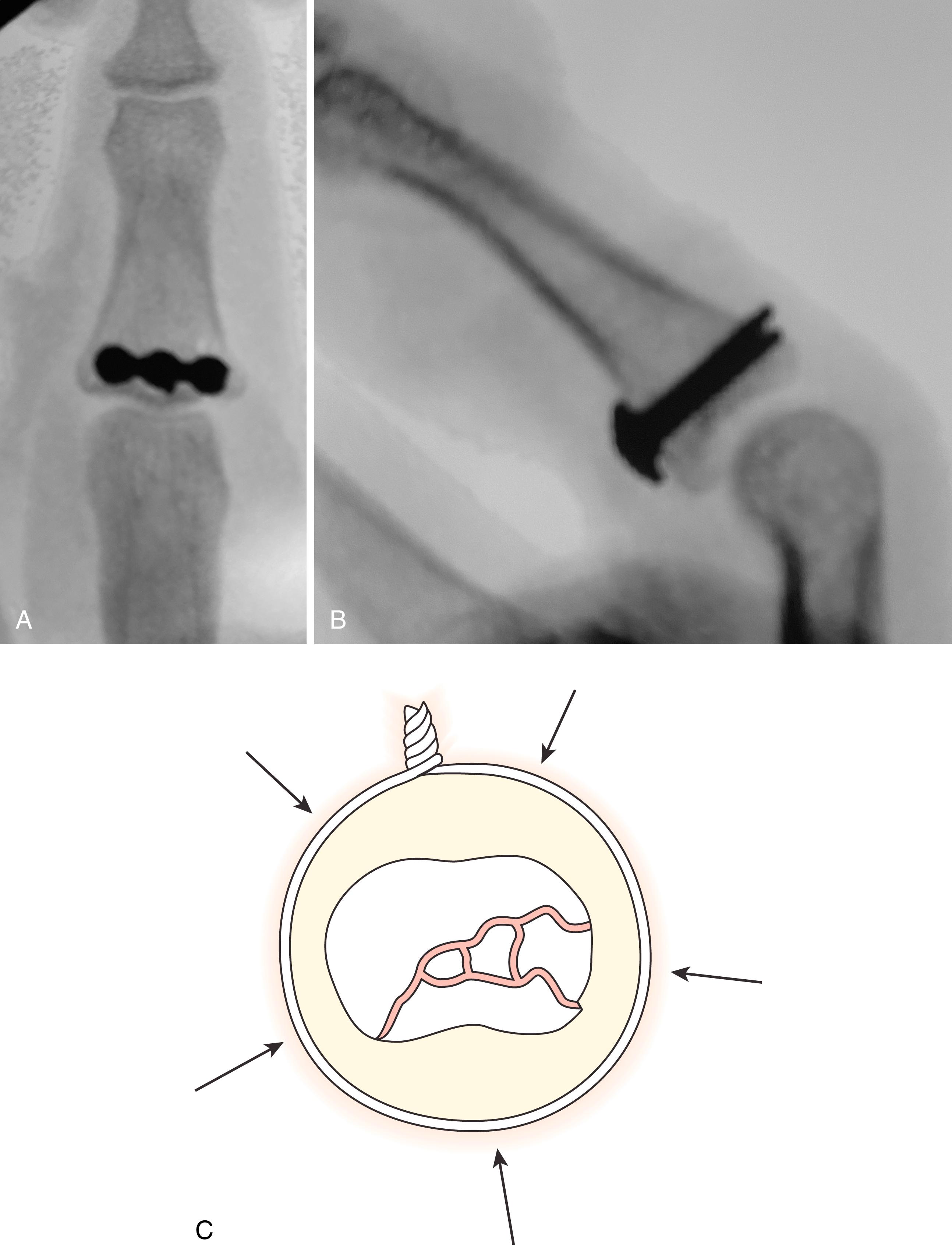 Fig. 8.15, After shotgun exposure of joint, fragments are managed with elevation and bone graft as needed. A and B, Three independent lag screws with or without a miniplate construct may be used to buttress the volar fragment. C, Alternatively, a cerclage wire is passed around the proximal end of the phalanx, preventing typical dorsal/volar expansion in pilon-type injuries and holding small fragments that otherwise may not be amenable to interfragmentary fixation.