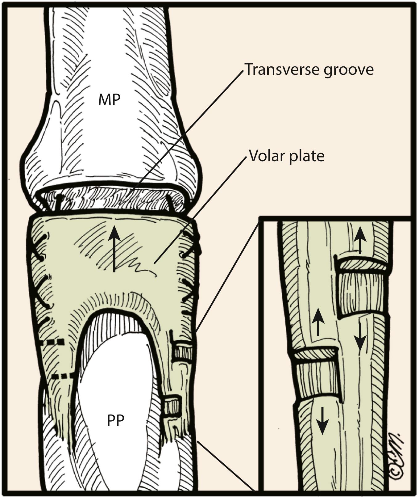 Fig. 8.17, Step-cuts can be made along checkrein ligaments to allow distal advancement of volar plate into the defect. MP, Metacarpophalangeal; PP, proximal phalanx.