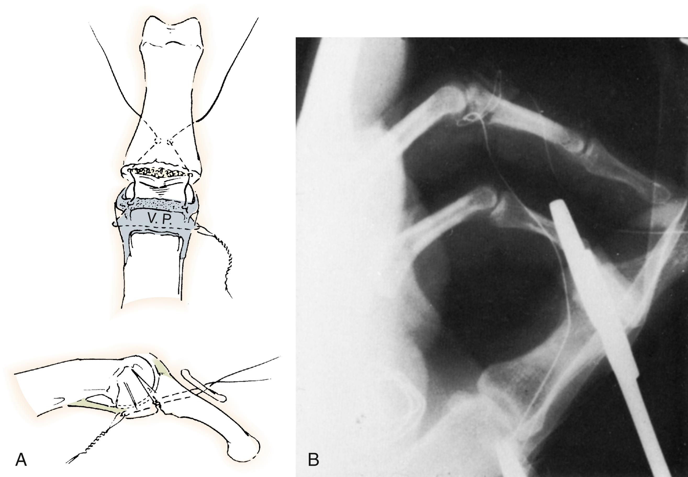 Fig. 8.18, A, Volar plate advanced into defect of reduced joint and held with pull-out wires over a button. B, Radiograph showing a reduced joint with volar plate advancement.