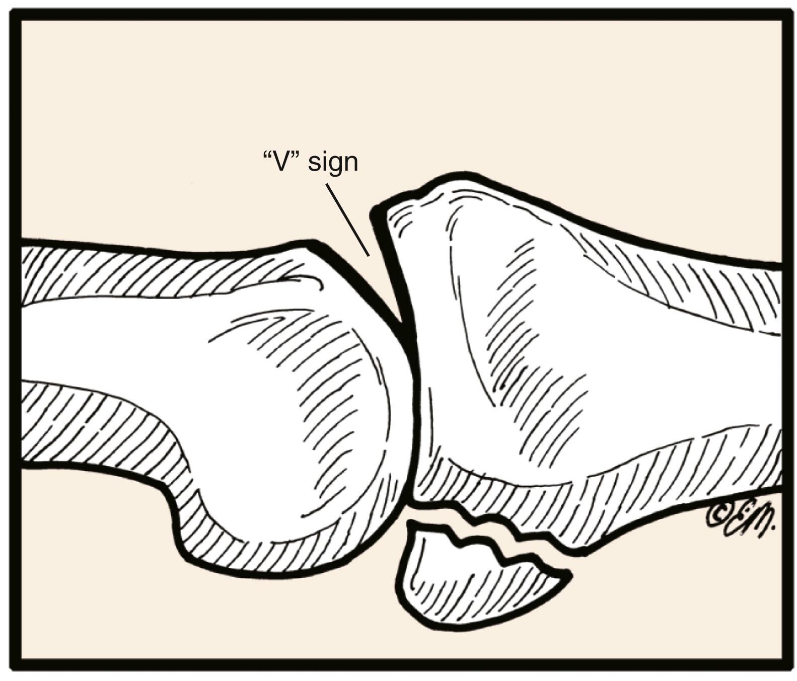 Fig. 8.2, Subtle proximal interphalangeal joint subluxation is recognized by dorsal joint widening known as the “V” sign.