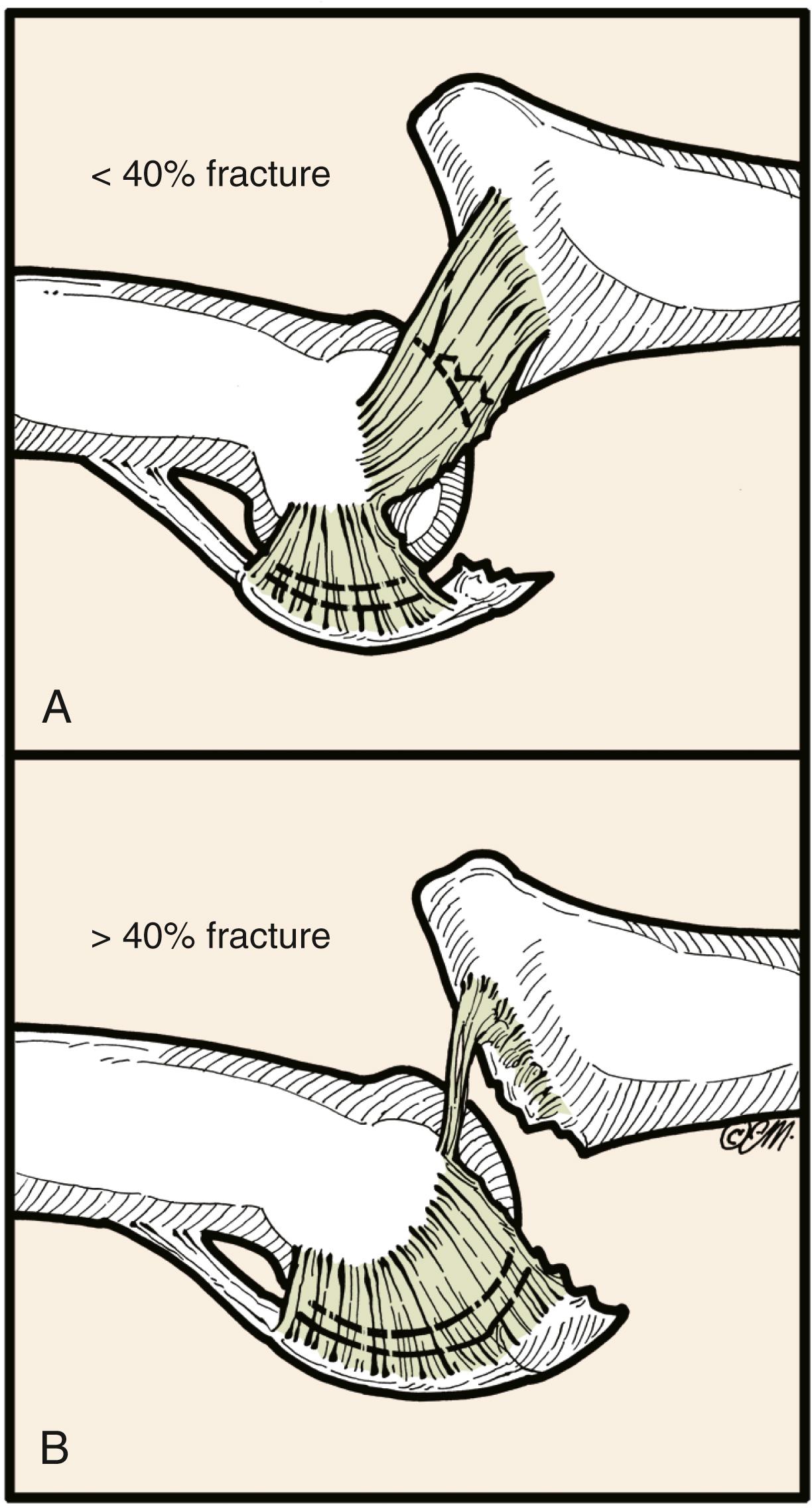Fig. 8.4, A, Fracture-dislocation with less than 40% of proximal articular surface allows some collateral ligament attachment to middle phalanx. B, A fracture-dislocation with more than 40% involvement of the middle phalangeal articular surface ensures that the collaterals are attached only to the fragment and not to the phalanx. The injury is unstable without operative fixation.