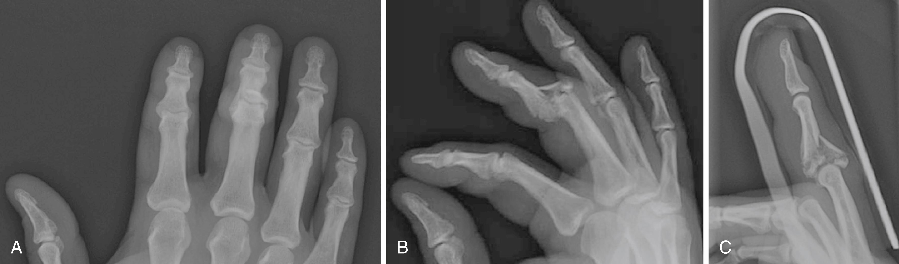 Fig. 8.7, A, Anteroposterior radiograph of pilon proximal interphalangeal joint injury with distal extension, shortening, and subluxation. B, Lateral radiograph of same injury before traction. C, Lateral radiograph after closed reduction.