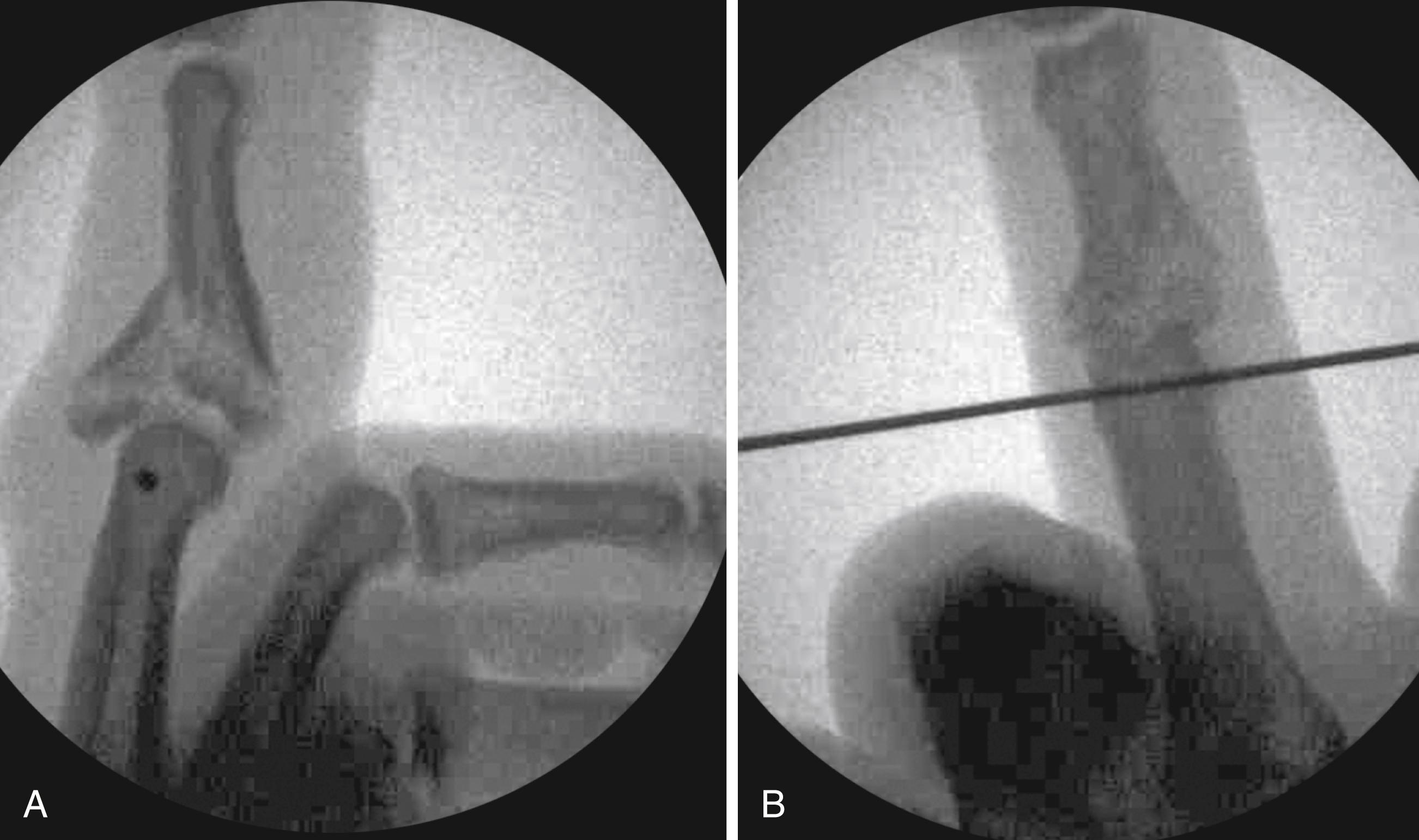 Fig. 8.8, A, Lateral radiograph of proximal wire placement near the center of rotation of the PIP joint. B, Anteroposterior radiograph of proximal wire placement transverse to longitudinal axis of finger.