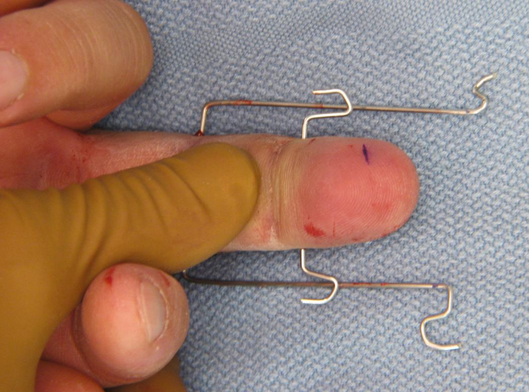 Fig. 8.9, Demonstration of wire placement with hooks made for dental rubber bands.