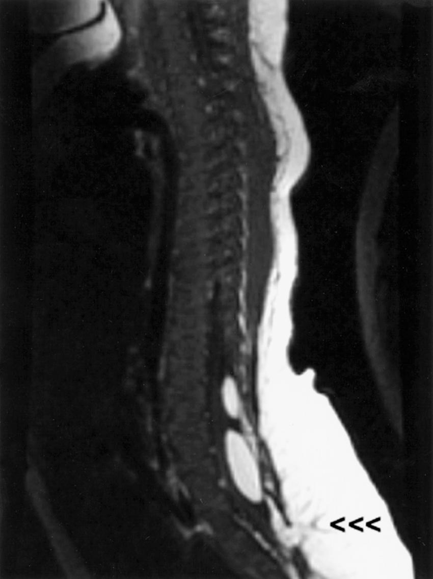 eFig. 104.9, Sagittal T1-weighted magnetic resonance image demonstrates several findings: low-lying conus medullaris, lipomas of filum terminale (bright signals within central canal), and spina bifida with protruding lipomyelomeningocele through the defect (arrowheads) .